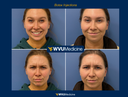 Botox Injections