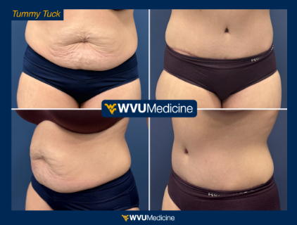 Abdominoplasty - Tummy Tuck