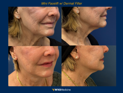 Mini Facelift w/ Dermal Fillers