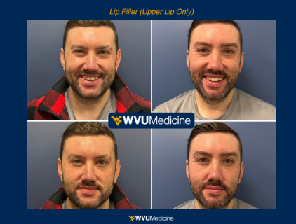 Top Lip Filler
