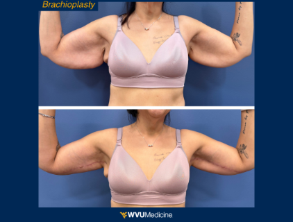 Brachioplasty - Arm Lift