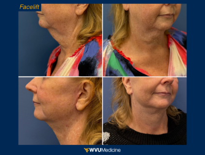 Facelift