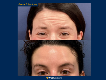 Botox Injections