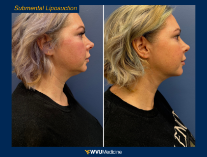 Submental Liposuction