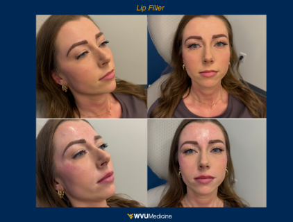 Lip Filler