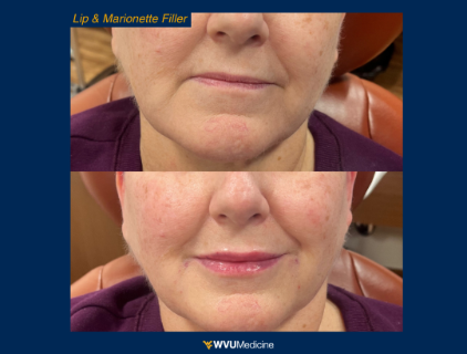 Lip & Marionette Filler