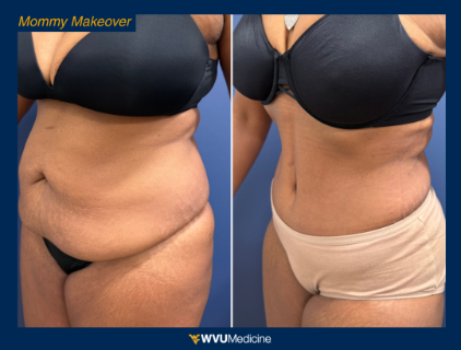 Mommy Makeover