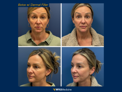 Botox & Filler